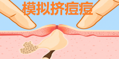 模拟挤痘痘游戏